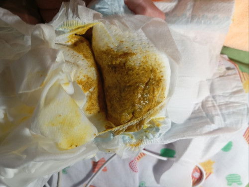 อึเด็กแรกเกิด