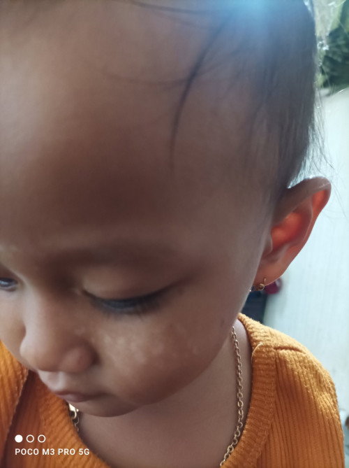 Bercak putih diwajah anak