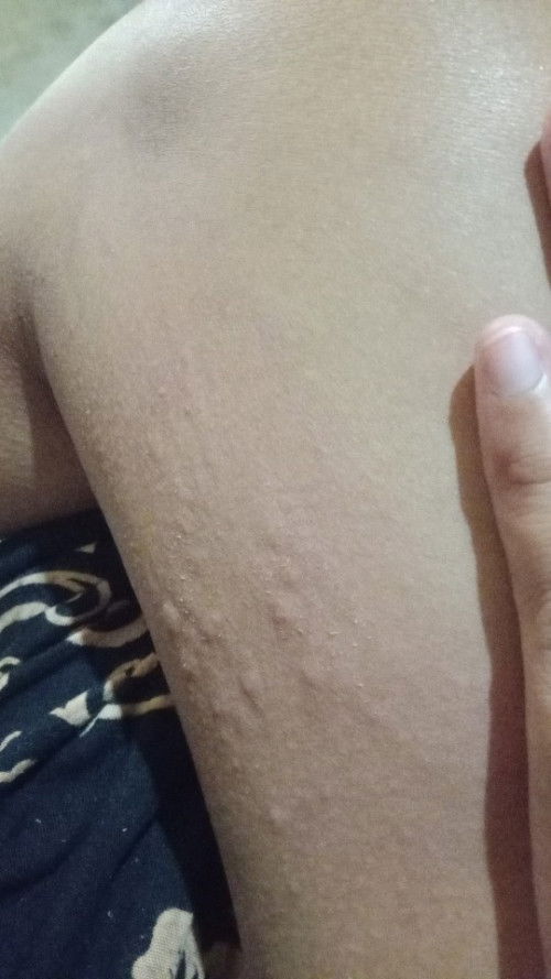 Gatal-gatal seperti biduran