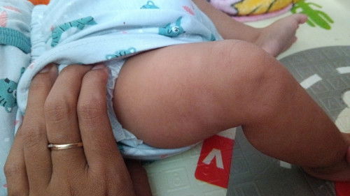 Kulit bayi muncul bercak putih dan kering