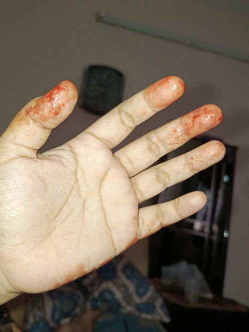 Check up cyst hari ni di hosp