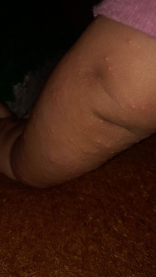 Apa ini campak atau bukan