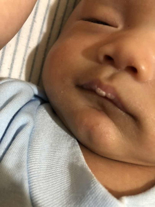 Bibir bayi kering