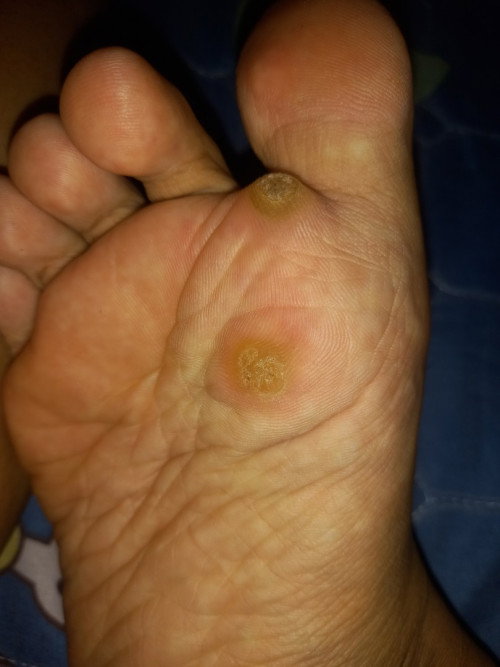 Muncul kaya gini ditelapak kaki kira² ada yang tau