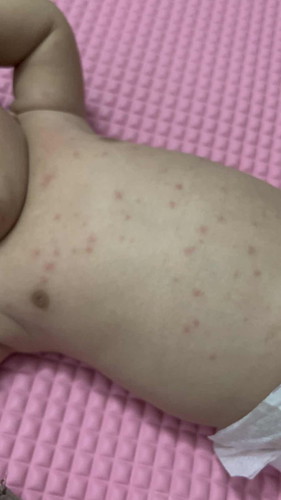 bintik merah pada badan baby