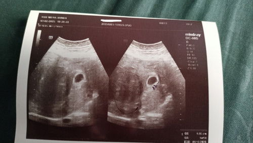 Miom 12 cm saat hamil