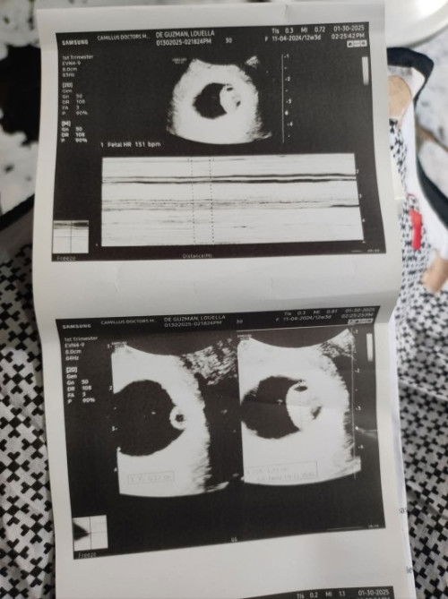 Tvs 7weeks 3days right ovaries