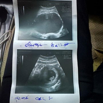 ท้องได้8สัปดาห์4วันตรวจเจอพร้อมกับซีส8-12เซนต์อันตรายต่อเด็กไหมค่ะ