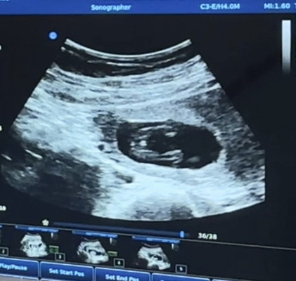 เบบี๋ 15w ไปอัลตราซาวด์ดูเพศ