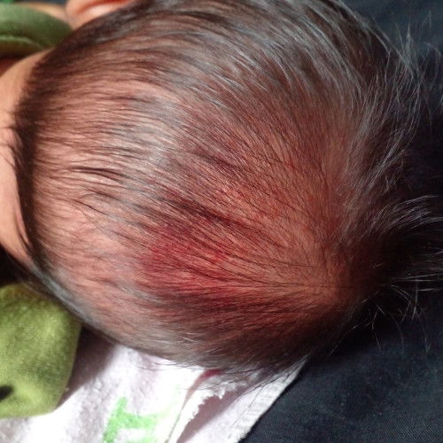 kepala bayi bagian belakang merah-merah