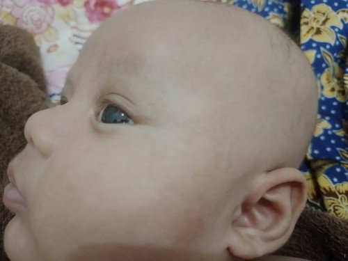 kulit bayi ada noda flek coklat