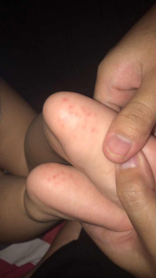 merah merah di tumit