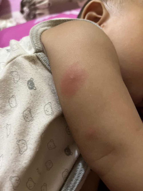 Bentol merah di bayik