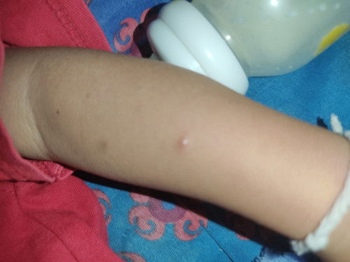 ตั้งแต่น้องเป็นส่าไข้มาน้องก็เป็นแบบนี้