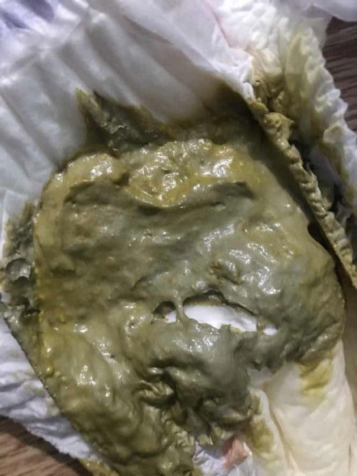 สีอึแบบนี้ปกติมั้ยคะ