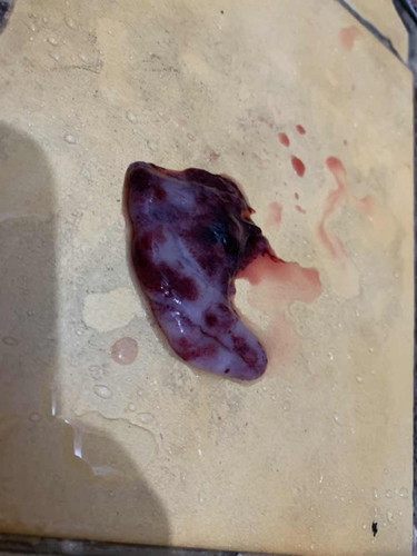 สวัสดีคะ อยากสอบถามคะแบบนี้เราแท้งไหมคะ ตรวจพบ2ขีดเมื่อ10มกรา มีอาการแบบนี้หลุดออกมา26มกราคะ ตอนนี้ผ่านมา11วันเเล้ว