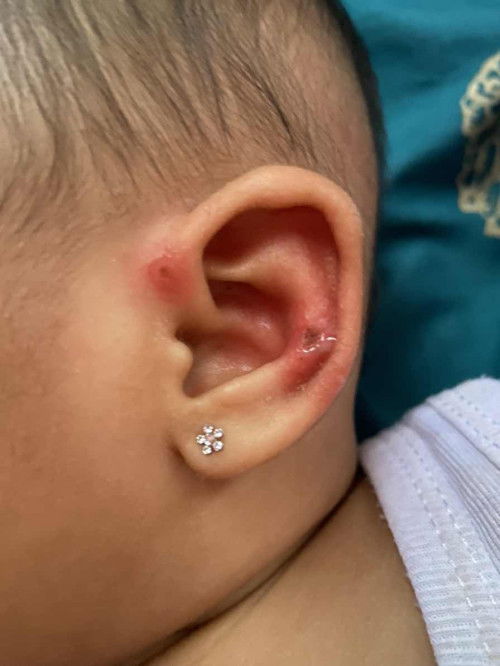 Telinga luka pada bayi 6 bulan