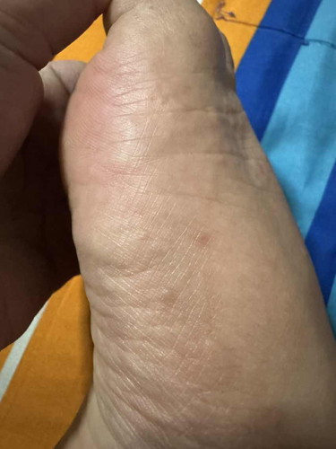 ท้อง30w+4 มีตุ่มคันใสๆที่มือและเท้า