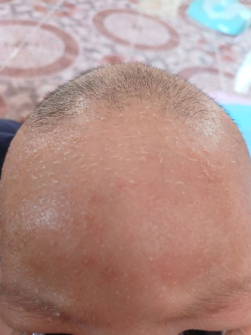 บ้านไหนเป็นบ้างคะบอกหน่อยค่ะใช้อะไรถึงหาย