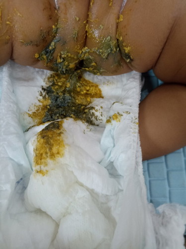 Wajar enggak bayi umur 3 bln warna pupnya kuning campur abu abu.. Apakah karna sufor?