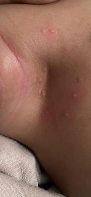 Bintik merah pada kulit bayi 3bln