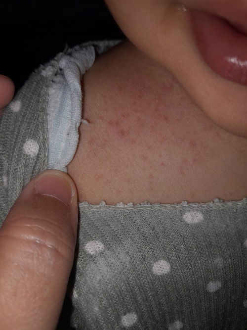 Alergi atau biang keringat ya