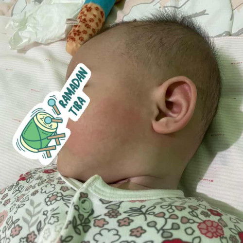 Apa ini gejela tampak?