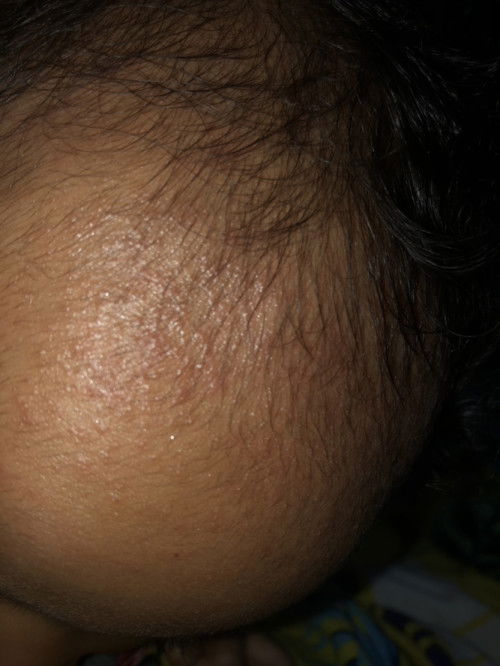 Kepala bayi bentol bentol kecil