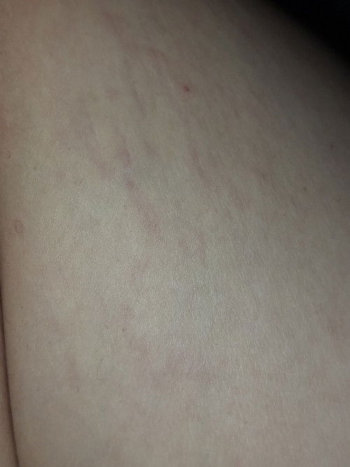 Ini strechmark bukan ya?