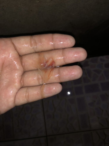 39วีคมีหมูกเลือดเเต่ไม่มีอาการเจ็บท้อง