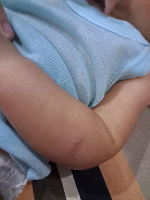 TANGAN SIKECIL LUKA SEPERTI GATEL