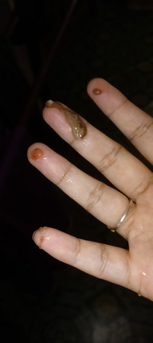 mucus plug