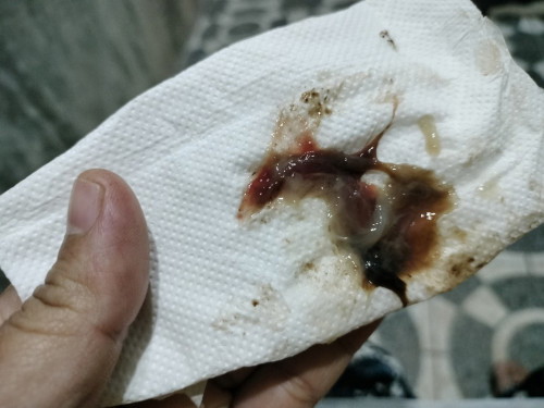 มีมูกปนเลือด