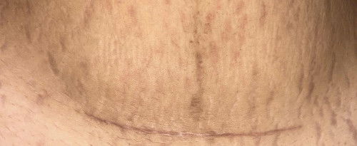 แผลผ่าคลอดปกติมั้ยคะ