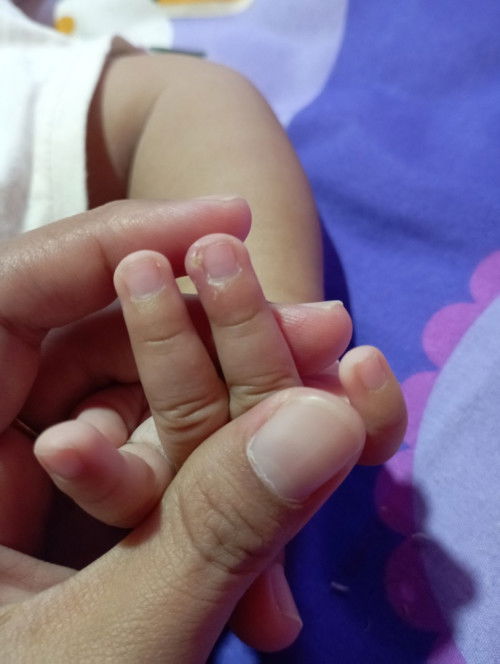 Kena kulitnya saat motong kuku