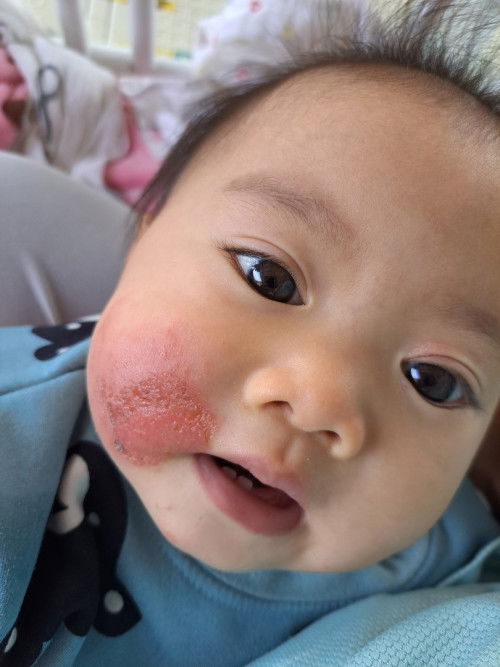 คุณแม่บ้านไหนลูกเคยเป็นแบบนี้บ้างไหมคะ?