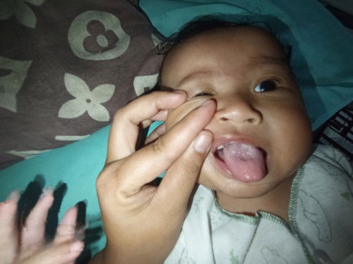 Gusi bayi putih tebal bagaimna cara mengatasinya ya bund? Mohon bantuan