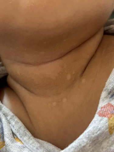 Ruam ke? Atau eczema