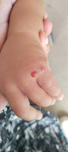 ลูกมีตุ่มน้ำที่มือ มือบวม