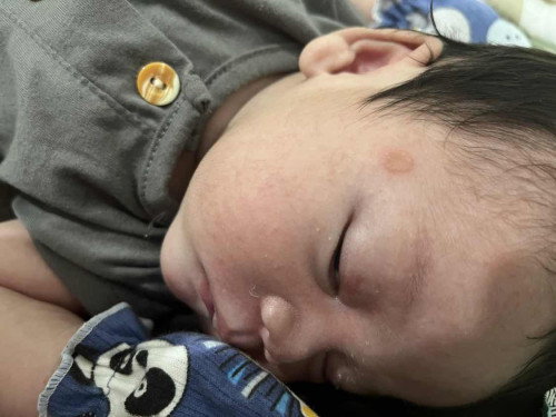 Jamur pada kulit bayi newborn