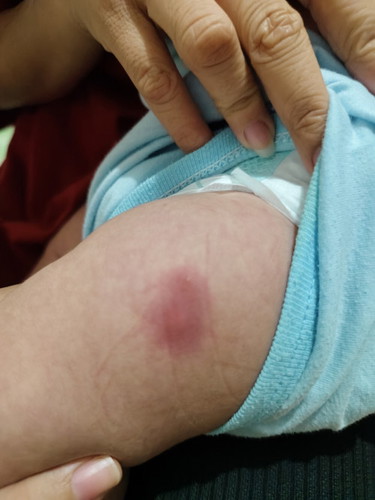 Paano MAWALA yung Maga sa Injection Ng Penta