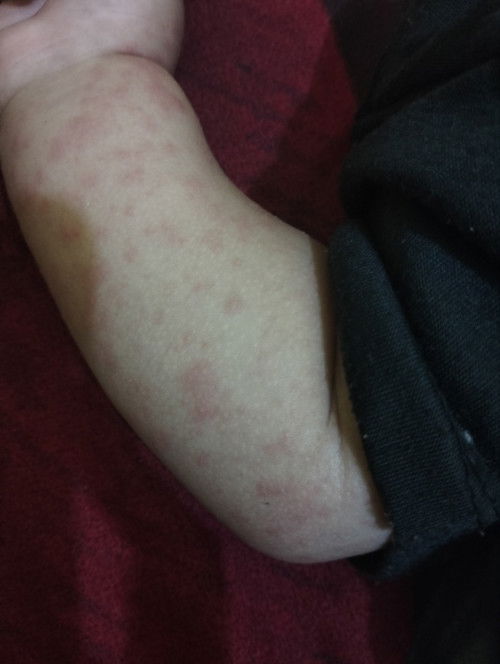 Bintik bintik merah pada kulit