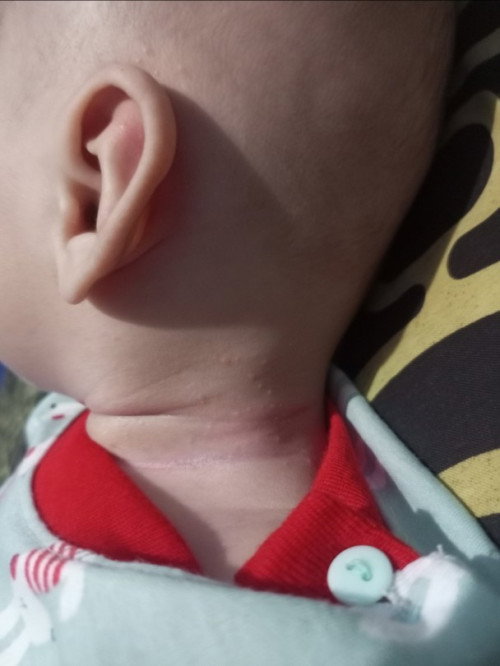 Bintik putih kecil kecil dilipatan leher bayi