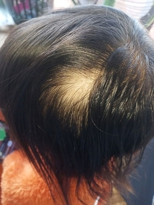 ลูกผมร่วงเกิดจากอะไร