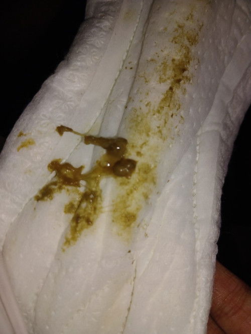 Keputihan hamil 37 week