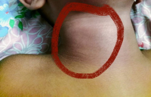 Hi semua, any idea ini rash apa?