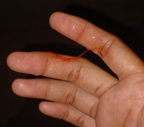 ท้อง35+3w มีเลือดปนมูกใสออก แล้วก็ปวดท้อง อันตรายมั้ยคะ หรือเป็นสัญญาณเตือนอะไรบ้างคะแม่ๆ