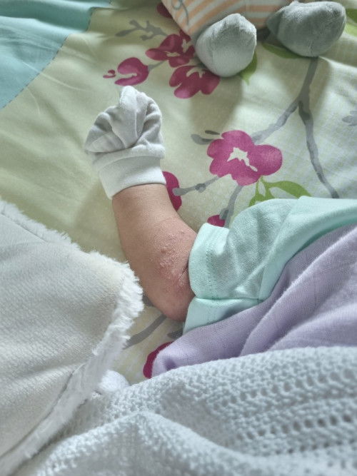 Baby 3 bulan kena chickenpox