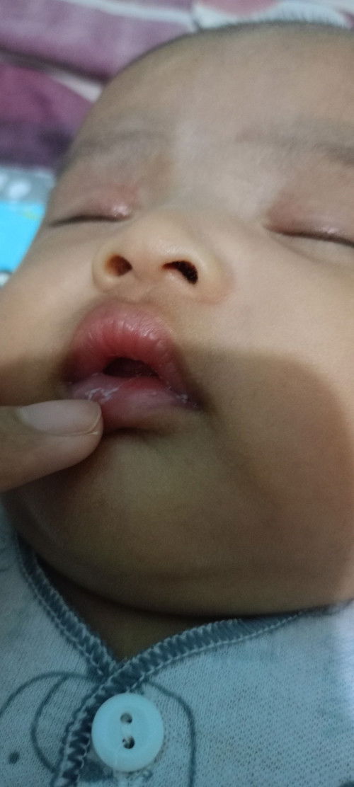Bibir seperti mau mengelupas,trs terkena asi jd putih
