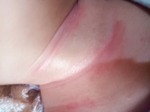 Merah merah pada leher bayi